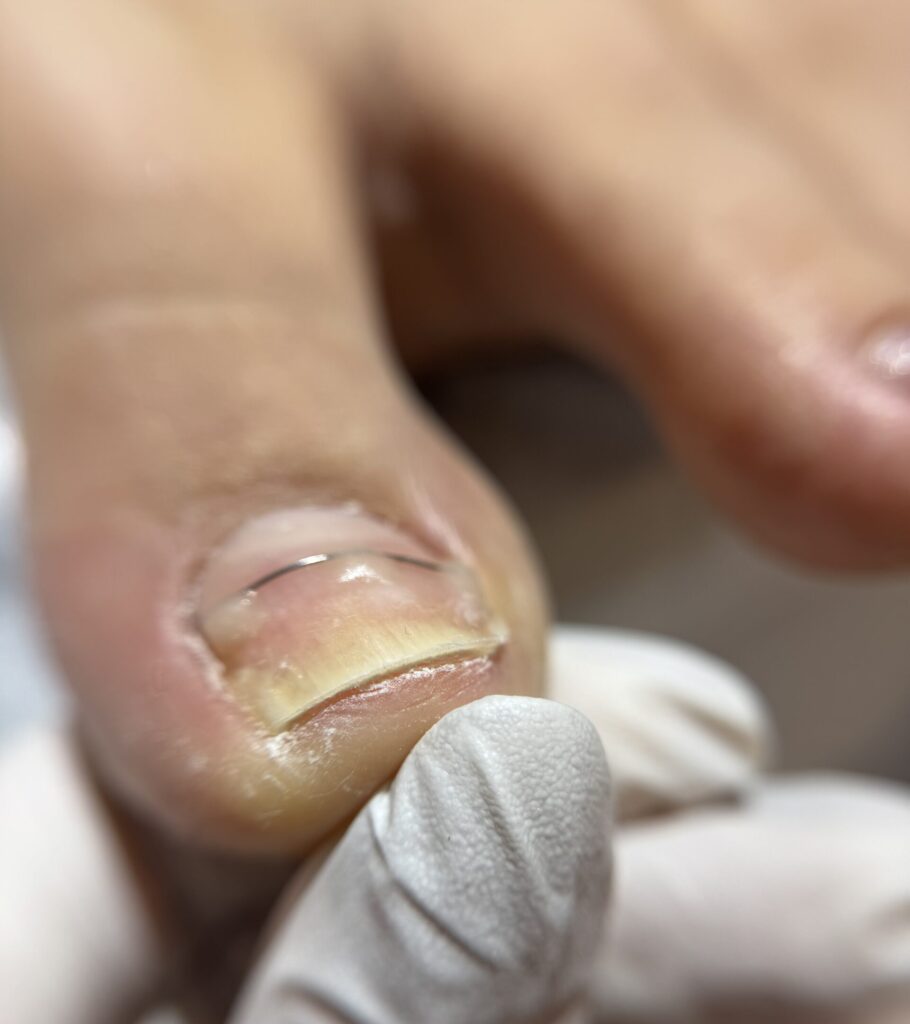 ﺳﺮوﯾﺲ درﻣﺎﻧﯽ ﻧﺎﺧﻨﻬﺎی ﭘﺎ )ارﺗﻮﻧﯿﻞ(