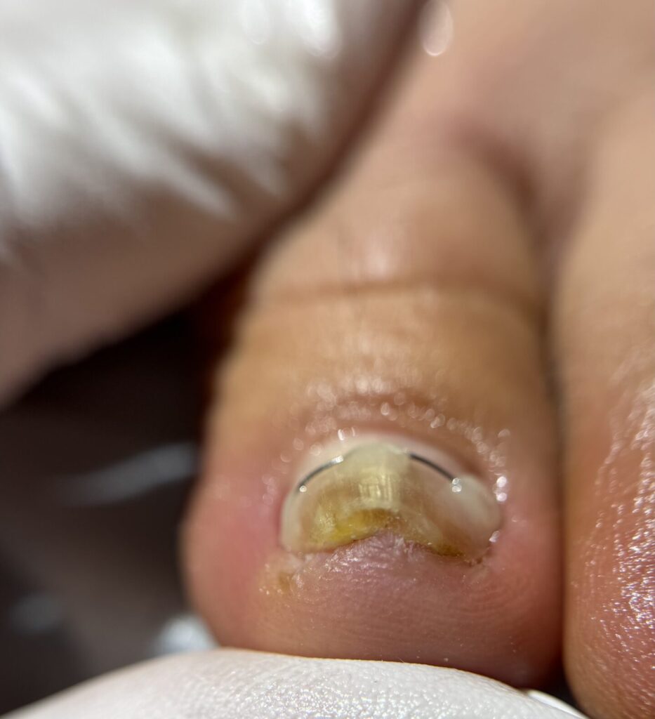 ﺳﺮوﯾﺲ درﻣﺎﻧﯽ ﻧﺎﺧﻨﻬﺎی ﭘﺎ )ارﺗﻮﻧﯿﻞ(